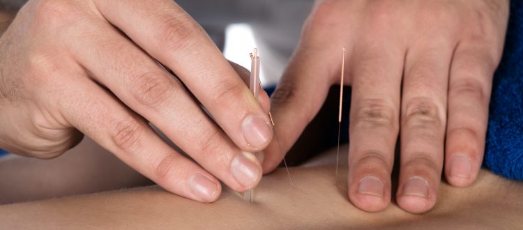 acupuncture for pain relief