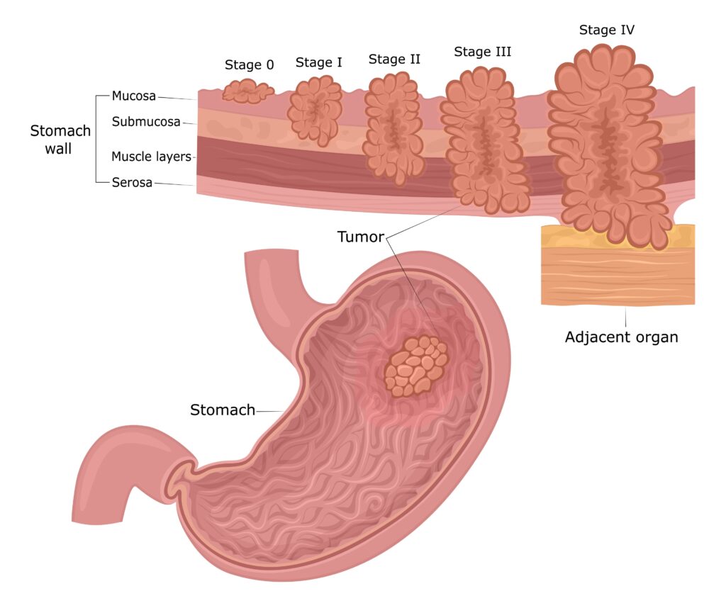Gastric Cancer Foundation Diagnosis Gastric Cancer Foundation Gastric Cancer Foundation Diagnosis Gastric Cancer Foundation